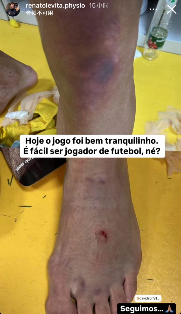 西海岸理療師曬戴維森腿部傷勢(shì)照：當(dāng)足球運(yùn)動(dòng)員很容易，對(duì)吧？