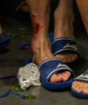 紅牌也不冤！被帕利尼亞蹬踏的波鴻球員，賽后小腿創(chuàng)口依然明顯